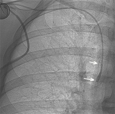 Brachial Approach As an Alternative Technique of Fibrin Sheath Removal for Implanted Venous Access Devices